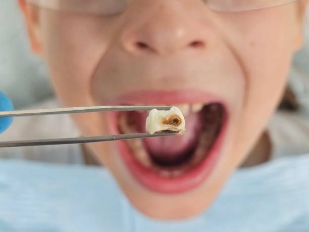 Best Emergency Treatment for Dental Infections or Abscesses in Jamestown West, NY
